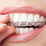 The Unseen Transformation: Invisalign Before And After